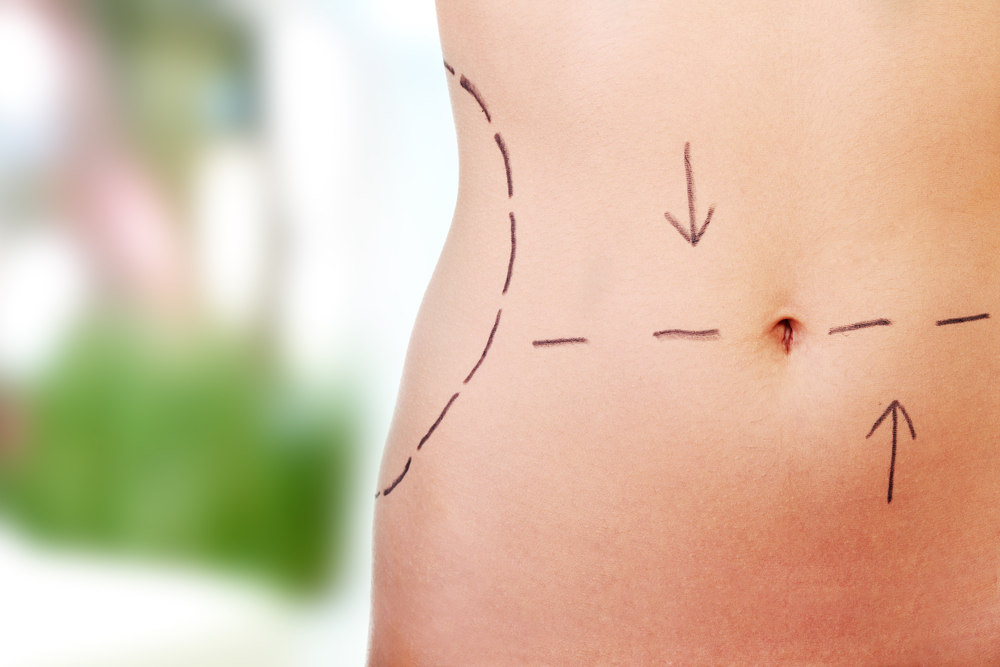 Repair Of A Hernia and Abdominoplasty Surgery Combined