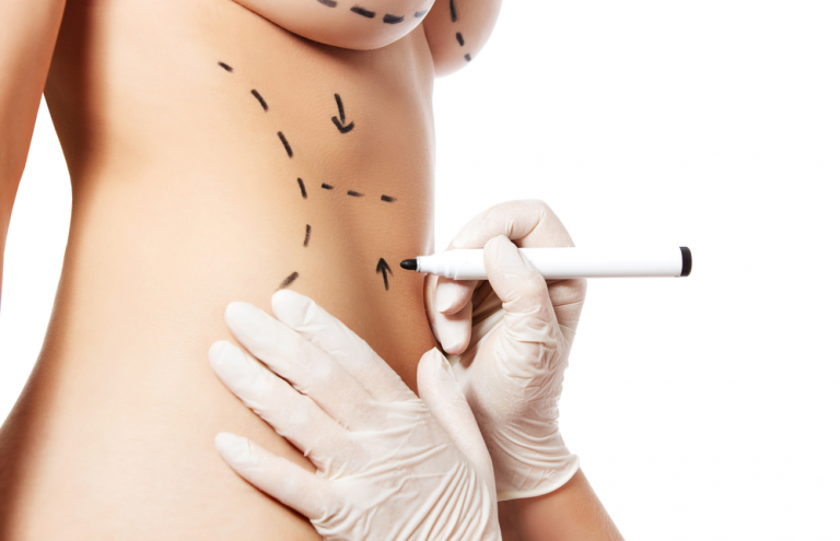 What Is Body Contouring Surgery?