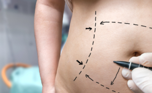 patient with drawing lines ready for tummy tuck