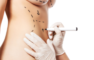 image of woman with pen marks ready for surgery