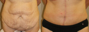 before and after image of fleur de abdominoplasty patient